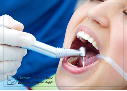 مراقبت بعد از پر كردن دندان چگونه است؟