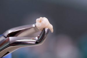 جراحی دندان عقل - بهترین جراح دندان عقل در تهران