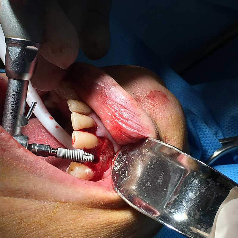 ایمپلنت دندان - جراح خوب ایمپلنت در تهران - دندانپزشکی در غرب تهران
