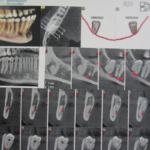 جراحی دندان عقل درگیر با عصب