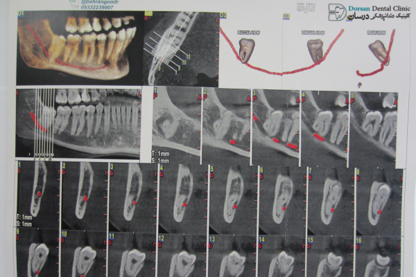 جراحی دندان عقل درگیر با عصب: نوع درگیری دندان عقل با عصب فک تحتانی بستگی به فرم ریشه ها و شکل دندان و محل رویش دارد و بسته به این موارد، نوع جراحی خارج کردن دندانهای عقل درگیر با عصب نیز متفاوت است.