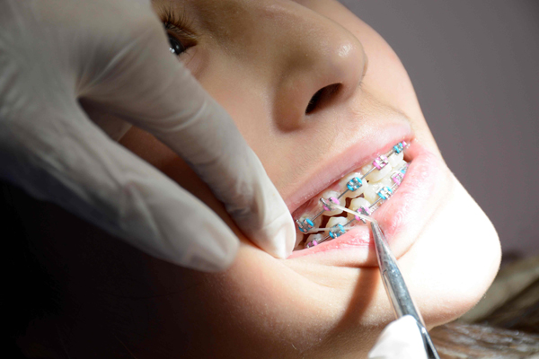 ارتودنسی ثابت چیست؟ مزایا و قیمت انواع آن: اگر به تشخیص متخصص و پس از رویش دندان‌های دائمی ناهنجاری دندانی در دهان بیماردیده شود درمان ارتودنسی ثابت اولین گزینه برای از بین بردن و کنترل بهم ریختگی ها و ناهنجاری های دندانی است.