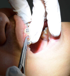 ارتودنسی ثابت چه مدت زمانی طول میکشد؟ طول درمان هر بیمار برای ارتودنسی ثابت متفاوت است. مدت زمان درمان بسته به طرح درمان و شرایط ناهنجاری و به‌هم‌ریختگی دندان‌ها دارد. معمولا حدود یک تا دو سال، ارتودنسی ثابت زمان می‌برد.